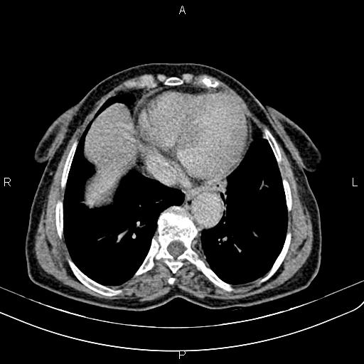 File:Aortic aneurysm and Lemmel syndrome (Radiopaedia 86499-102554 Axial C+ delayed 5).jpg