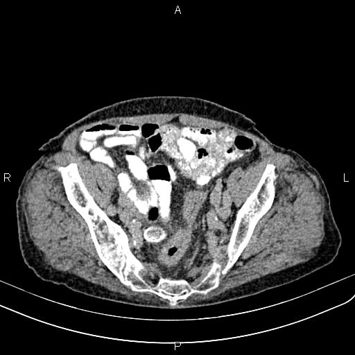 File:Aortic aneurysm and Lemmel syndrome (Radiopaedia 86499-102554 Axial C+ delayed 63).jpg
