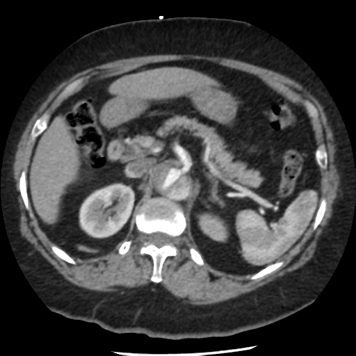 Aortic aneurysm and dissection - Stanford type A (Radiopaedia 36693-38261 A 52).png