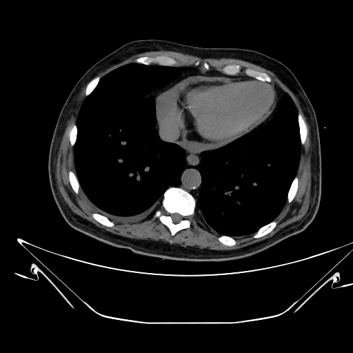 Aortic arch aneurysm (Radiopaedia 84109-99365 Axial non-contrast 206).jpg