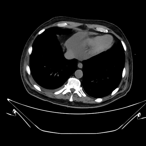 Aortic arch aneurysm (Radiopaedia 84109-99365 Axial non-contrast 217).jpg