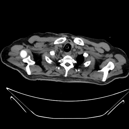 Aortic arch aneurysm (Radiopaedia 84109-99365 Axial non-contrast 31).jpg