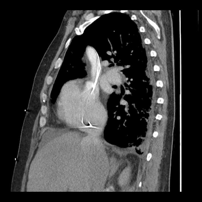 Aortic arch graft infection (FDG PET-CT) (Radiopaedia 71975-82437 C 24).jpg