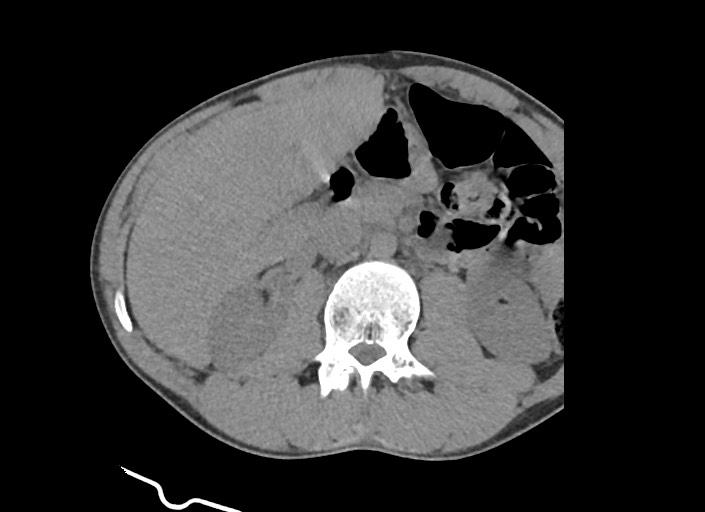 File:Aortic coarctation with aneurysm (Radiopaedia 74818-85828 A 5).jpg