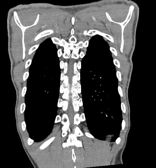 File:Aortic coarctation with aneurysm (Radiopaedia 74818-85828 C 99).jpg