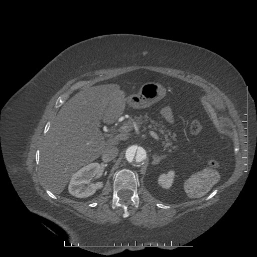 Aortic dissection- Stanford A (Radiopaedia 35729-37268 B 48).jpg