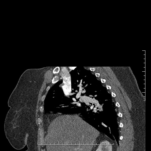 File:Aortic dissection- Stanford A (Radiopaedia 35729-37268 D 49).jpg