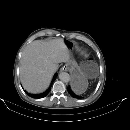 File:Aortic dissection- Stanford type A (Radiopaedia 22085-22085 Axial C+ delayed 8).jpg