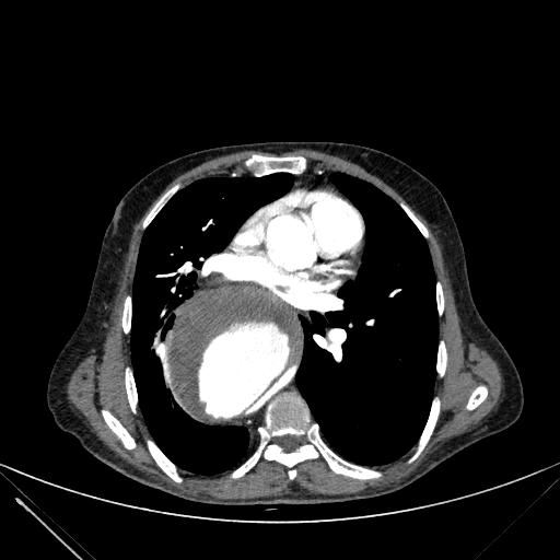 Aortic dissection (Radiopaedia 27466-27665 C+ arterial phase 138).jpg