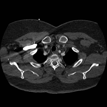 Aortic dissection (Radiopaedia 57969-64959 A 47).jpg