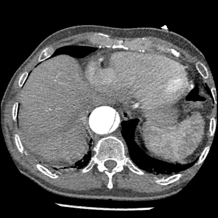 Aortic dissection - DeBakey Type I-Stanford A (Radiopaedia 79863-93115 A 32).jpg