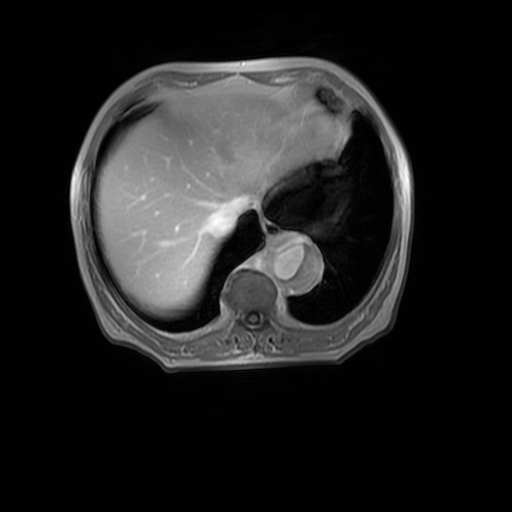 File:Aortic dissection - Stanford A - DeBakey I (Radiopaedia 23469-23551 Axial MRA 32).jpg