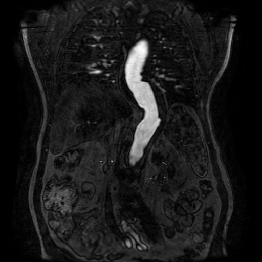 Aortic dissection - Stanford A - DeBakey I (Radiopaedia 23469-23551 D 153).jpg