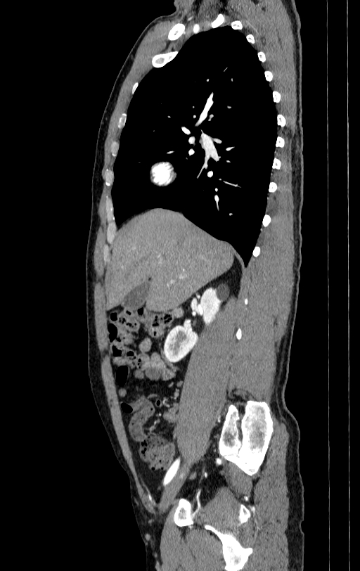 Aortic dissection - Stanford type A (Radiopaedia 83418-98500 B 2).jpg