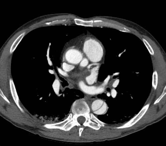 Aortic dissection - Stanford type B (Radiopaedia 73648-84437 A 54).jpg