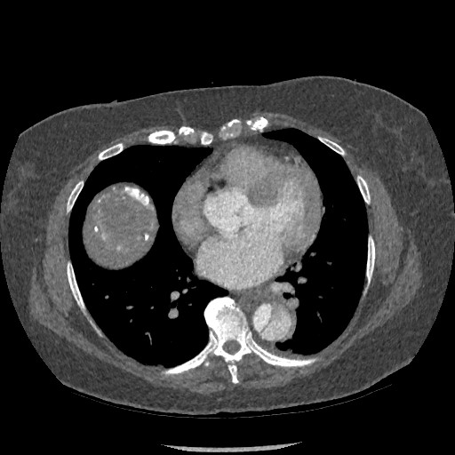 Aortic dissection - Stanford type B (Radiopaedia 88281-104910 A 54).jpg