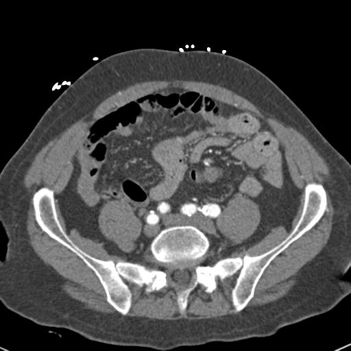 Aortic intramural hematoma (Radiopaedia 31139-31838 B 132).jpg