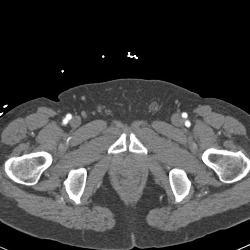 Aortic intramural hematoma (Radiopaedia 31139-31838 B 174).jpg
