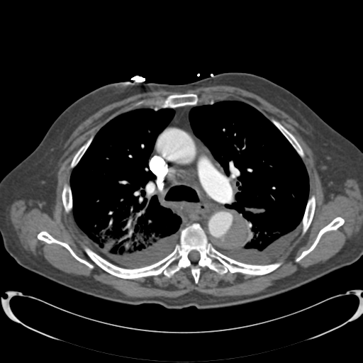 Aortic intramural hematoma (Radiopaedia 34260-35540 B 15).png