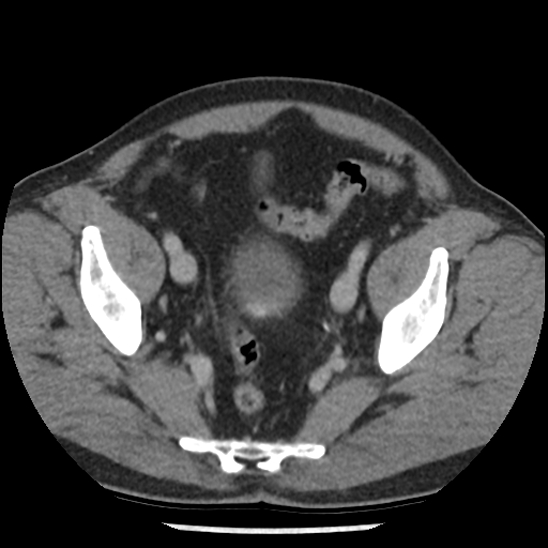 Aortic intramural hematoma (type B) (Radiopaedia 79323-92387 Axial C+ delayed 102).jpg