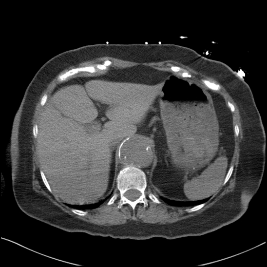 Aortic intramural hematoma with dissection and intramural blood pool (Radiopaedia 77373-89491 Axial non-contrast 93).jpg