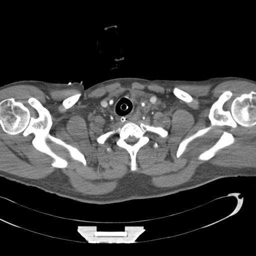 Aortic transection, diaphragmatic rupture and hemoperitoneum in a complex multitrauma patient (Radiopaedia 31701-32622 A 7).jpg