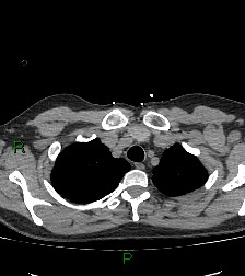 Aortic valve endocarditis (Radiopaedia 87209-103485 Axial non-contrast 20).jpg