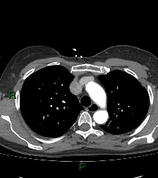 File:Aortic valve endocarditis (Radiopaedia 87209-103485 C 27).jpg