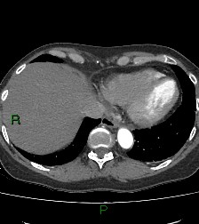 Aortic valve endocarditis (Radiopaedia 87209-103485 C 76).jpg