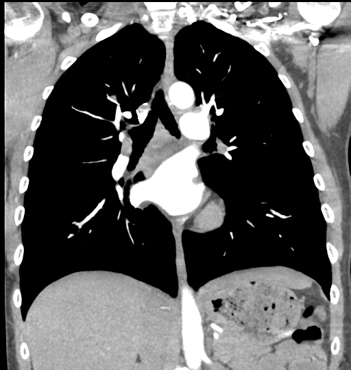 Aortic valve non-coronary cusp thrombus (Radiopaedia 55661-62189 C 43).png