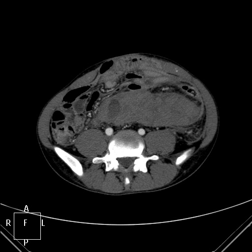 File:Aorto-left renal vein fistula (Radiopaedia 45534-49628 A 50).jpg