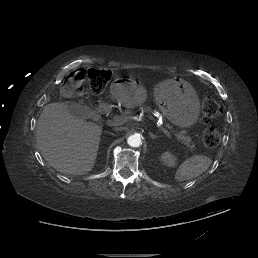 Aortoesophageal fistula with endovascular repair (Radiopaedia 73781-84592 Axial C+ CTPA 189).jpg