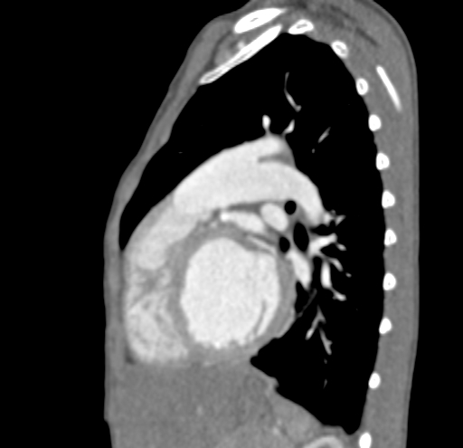 File:Aortopulmonary window, interrupted aortic arch and large PDA giving the descending aorta (Radiopaedia 35573-37074 C 33).jpg