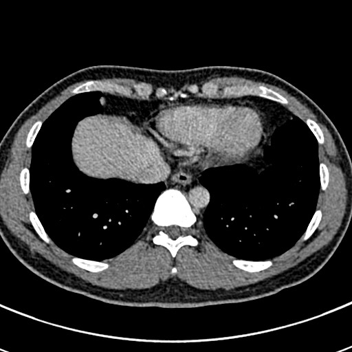 File:Apical lung mass mimic - neurogenic tumor (Radiopaedia 59918-67521 A 63).jpg