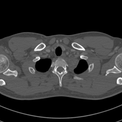 Apical lung mass mimic - neurogenic tumor (Radiopaedia 59918-67521 Axial bone window 7).jpg