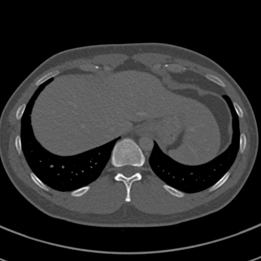 Apical lung mass mimic - neurogenic tumor (Radiopaedia 59918-67521 Axial bone window 71).jpg