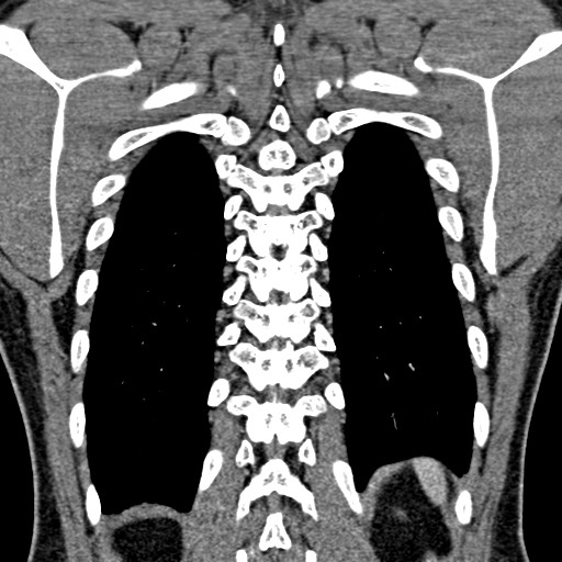 Apical lung mass mimic - neurogenic tumor (Radiopaedia 59918-67521 B 89).jpg