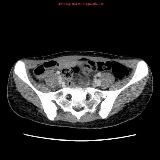 File:Appendiceal abscess (Radiopaedia 13096-13151 A 1).jpg