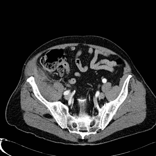 Appendiceal adenocarcinoma complicated by retroperitoneal abscess (Radiopaedia 58007-65039 B 110).jpg