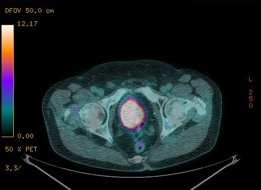 Appendiceal adenocarcinoma complicated by retroperitoneal abscess (Radiopaedia 58007-65041 Axial PET-CT 186).jpg