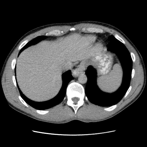 File:Appendicitis complicated by post-operative collection (Radiopaedia 35595-37113 A 7).jpg