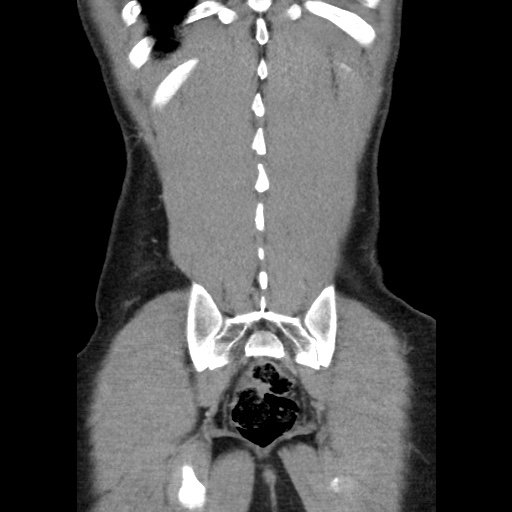 File:Appendicitis complicated by post-operative collection (Radiopaedia 35595-37113 B 47).jpg
