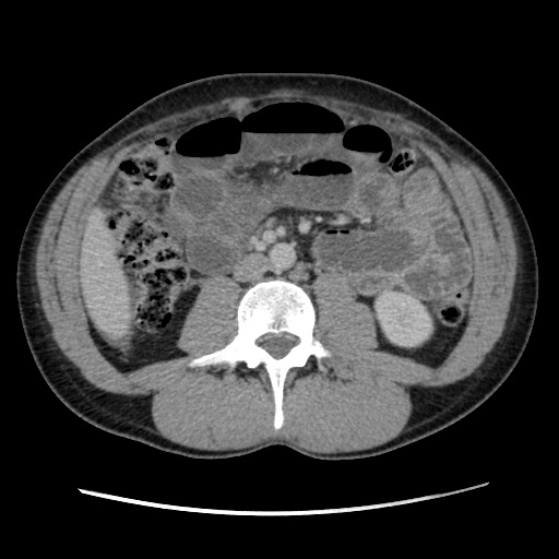 Appendicitis complicated by post-operative collection (Radiopaedia 35595-37114 A 43).jpg