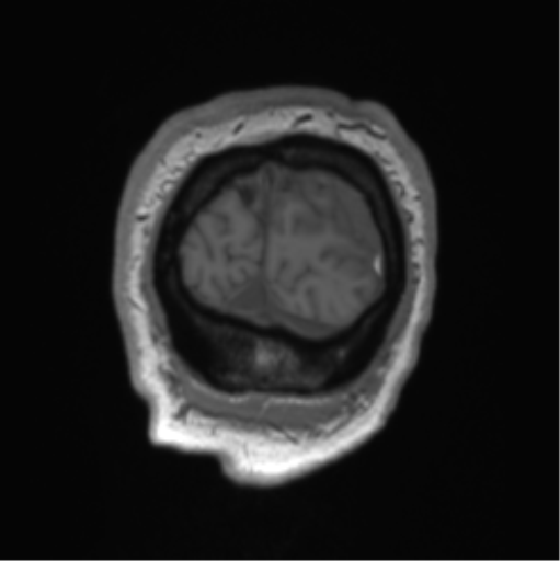 Arachnoid cyst with subdural hematoma (Radiopaedia 85892-101743 Coronal T1 5).png