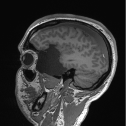 Arachnoid cyst with subdural hematoma (Radiopaedia 85892-101743 Sagittal T1 28).png