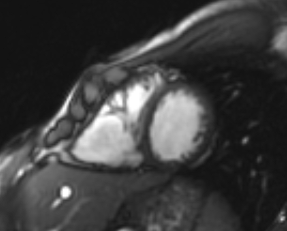 File:Arrhythmogenic right ventricular cardiomyopathy (Radiopaedia 69564-79464 short axis cine 97).jpg
