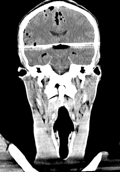 Arrow injury to the brain (Radiopaedia 72101-82607 Coronal non-contrast 42).jpg
