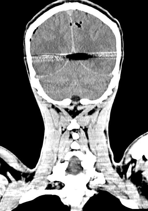 Arrow injury to the brain (Radiopaedia 72101-82607 Coronal non-contrast 56).jpg