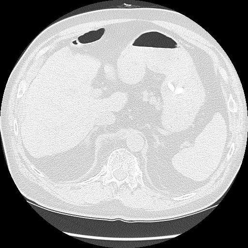 Asbestos-related pleural disease (Radiopaedia 74366-85250 Axial lung window 111).jpg