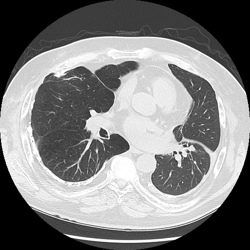 Asbestos-related pleural disease (Radiopaedia 74366-85250 Axial lung window 64).jpg